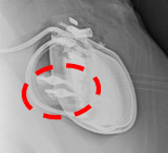 刺激装置の背部に写るポケットアダプタ (斜め横からのX線像)